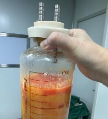 项城水动力吸脂手术要做多久？